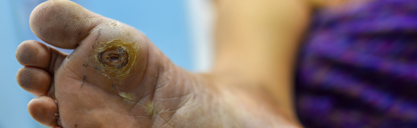 title_image_diabetic_foot